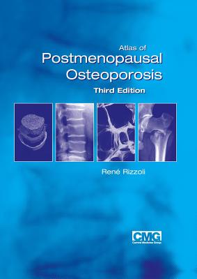 Atlas of Postmenopausal Osteoporosis: Third Edition